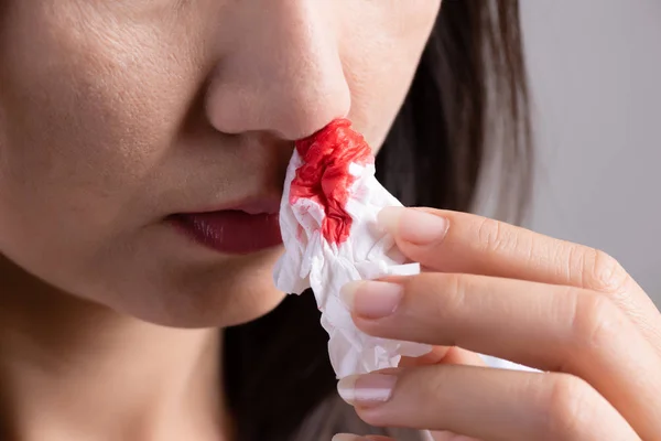 Näsblod, en ung kvinna som lider av näsblödning och som använder mjukpapper för att stoppa blödning. Hälso-och sjukvårds koncept. — Stockfoto