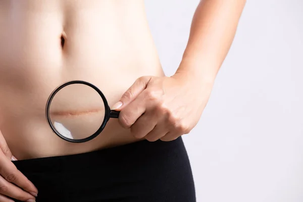 Fechamento da mulher que mostra na barriga a cicatriz escura de uma cesariana. Conceito de saúde . — Fotografia de Stock