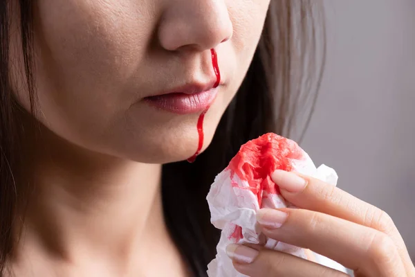 Näsblod, en ung kvinna som lider av näsblödning och som använder mjukpapper för att stoppa blödning. Hälso-och sjukvårds koncept. — Stockfoto