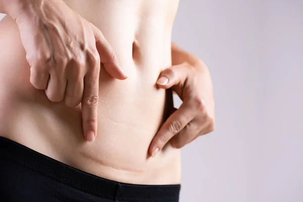 Nahaufnahme einer Frau, die auf ihrem Bauch eine dunkle Narbe vom Kaiserschnitt zeigt. Gesundheitskonzept. — Stockfoto