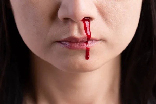 鼻血を出した 若い女性ヘルスケアと医療の概念. — ストック写真