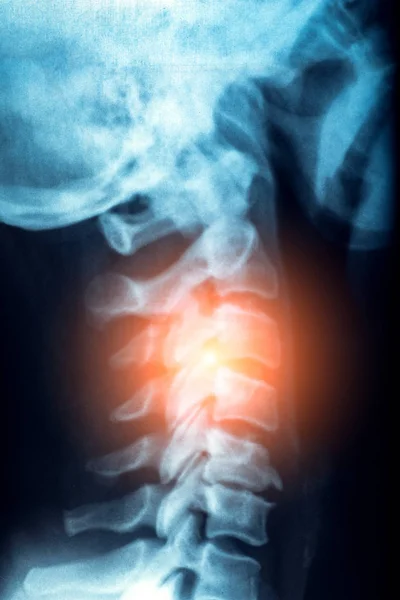 X-ışını veya insan boyun Mr ile ağrı ve stres omurga veya omurga, travma ve romatizma kavramı kırmızı bölge — Stok fotoğraf