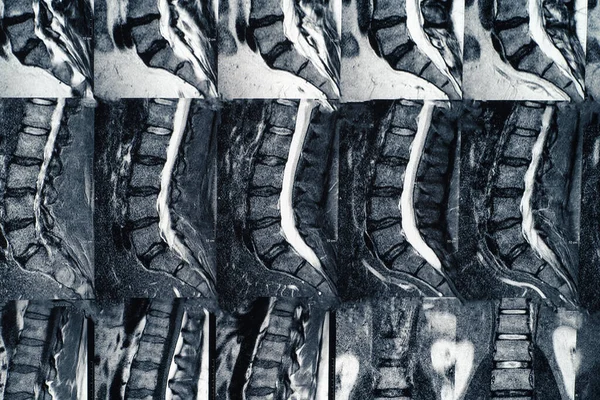 Makro foto MRI bederní páteře s osteochondrózou, věkem podmíněné změny v kotoučích obratlů a štípaných nervů — Stock fotografie