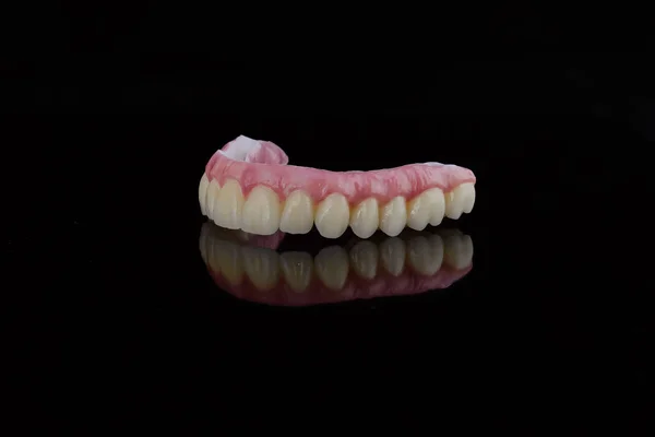 Hoge kwaliteit tandprothese gemaakt door tandtechnicus, prothese met een roze gingiva te repareren na implantatie. — Stockfoto