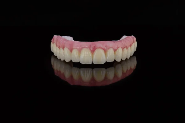 Hoge kwaliteit tandprothese gemaakt door tandtechnicus, prothese met een roze gingiva te repareren na implantatie. — Stockfoto