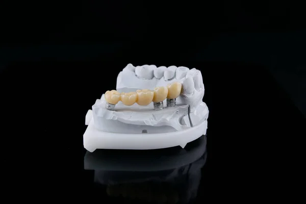 Puente de prótesis dental de alta calidad hecho de zirconia y coronas de cerámica en el modelo desde la posición de mordida. —  Fotos de Stock