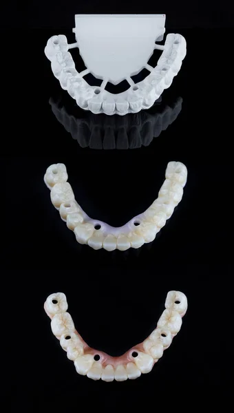 Tres etapas de la realización de prótesis de circonio dental completa sobre implantes. Concepto de cuidado dental. —  Fotos de Stock