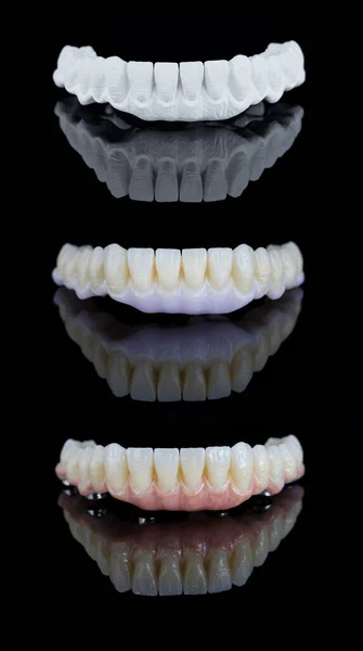 이 식체에 완전 한 치아 간경화 보철을 만드는 세 단계. 치과 치료 개념. — 스톡 사진