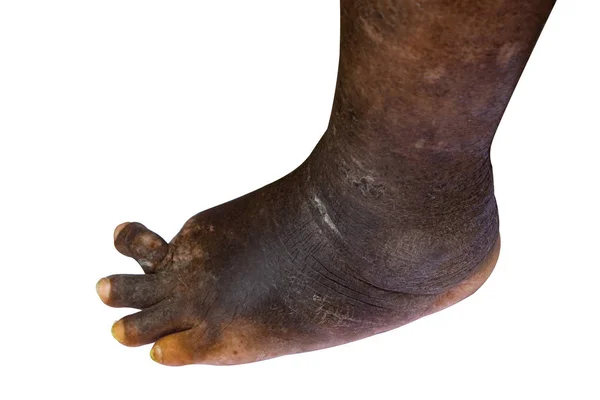 一般的な足の条件付けの糖尿病医療がある白い背景で隔離の潰瘍 — ストック写真
